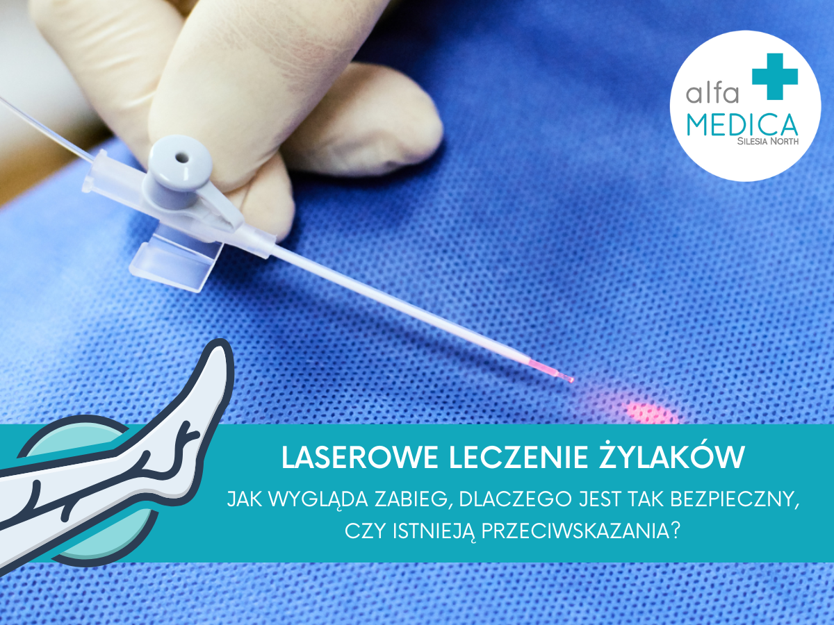 Laserowe leczenie żylaków