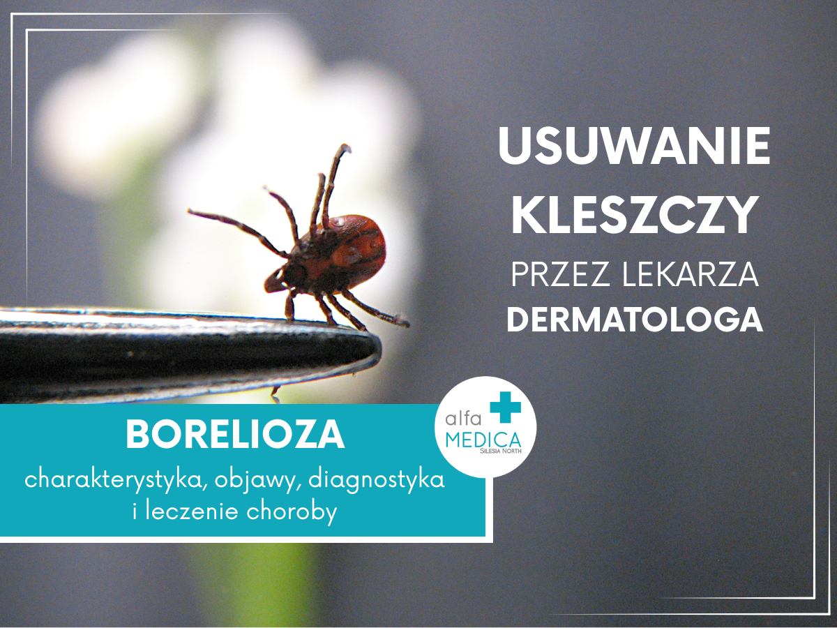 Borelioza usuwanie kleszczy