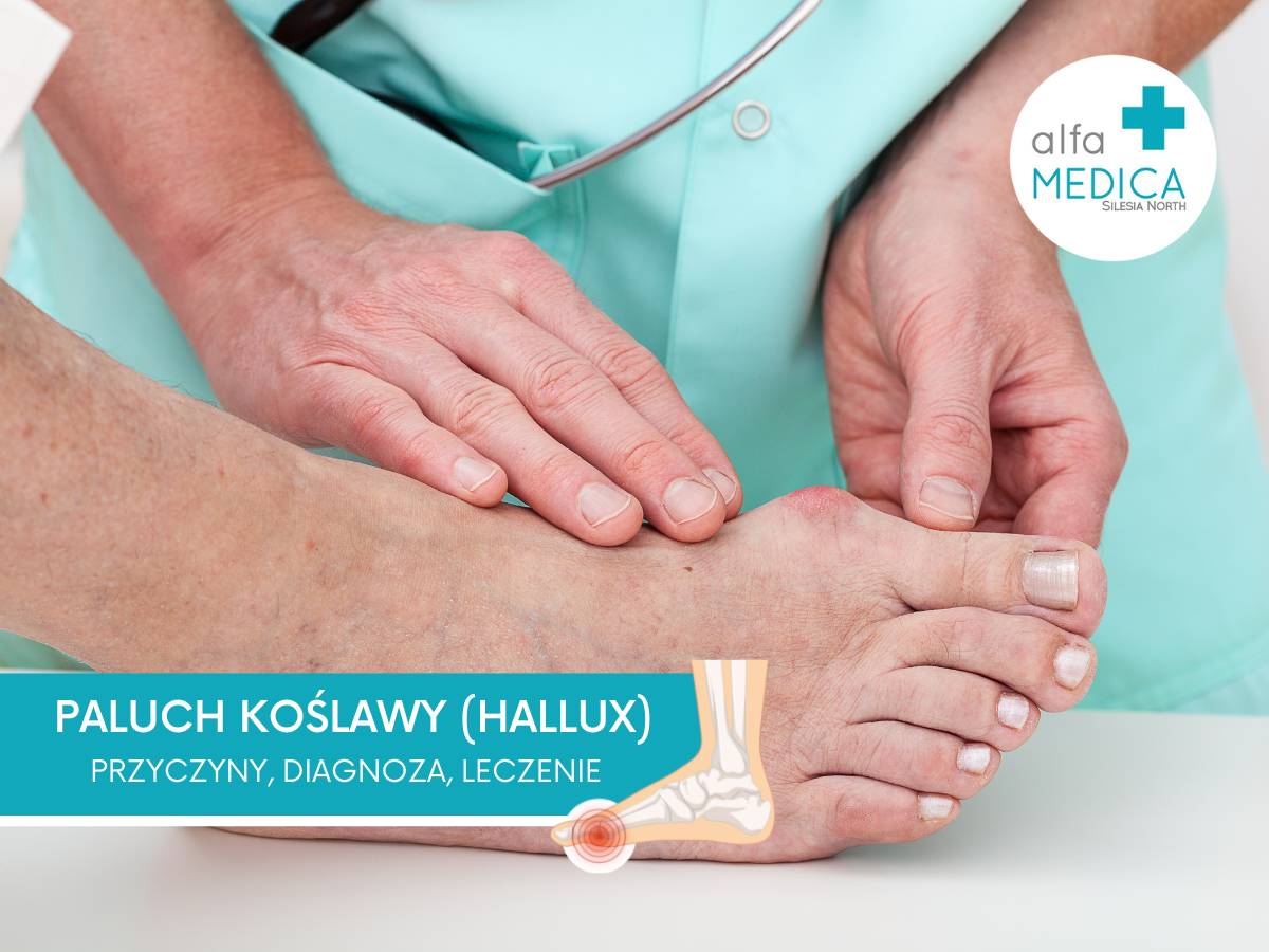 PALUCH KOŚLAWY (HALLUX)